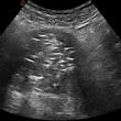 4 cm-es mióma ultrahangos képe embolizáció után. A gócon belül látható „fehér csíkok” jelzik az embolizáció sikerességét